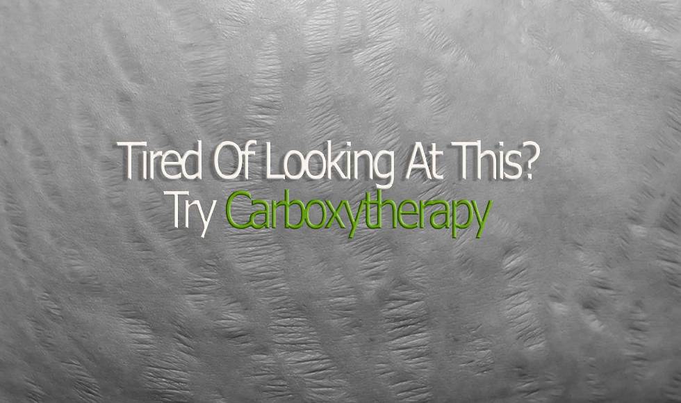 CarboxyTherapy Stretch Mark Treatment Toronto
