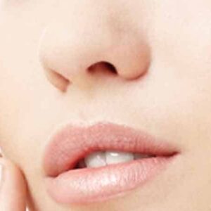 Upper Lip Laser Hair Removal