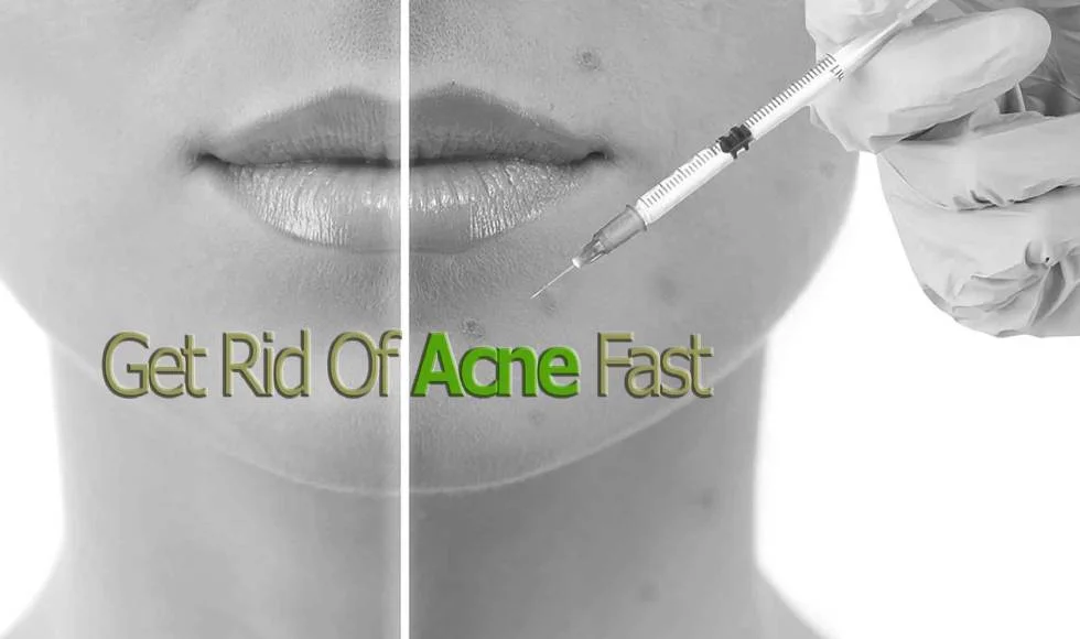Acne Injections Banner