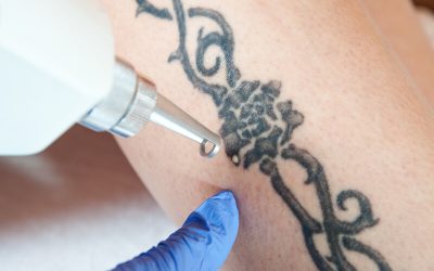 Preparing for Your First Tattoo Removal Session