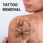 Tattoo Removal 4″ x 4″ Area pkgs