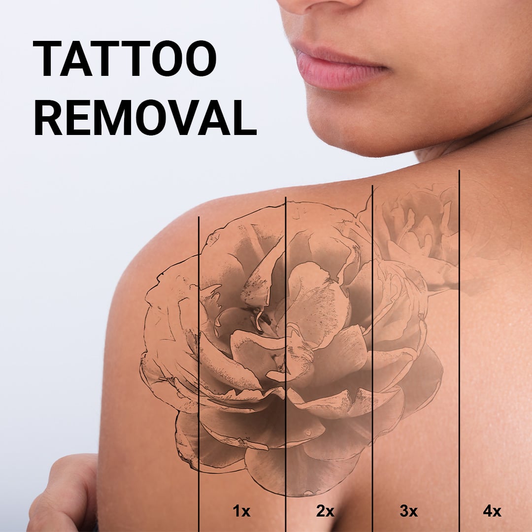 Tattoo Removal 4″ x 4″ Area pkgs