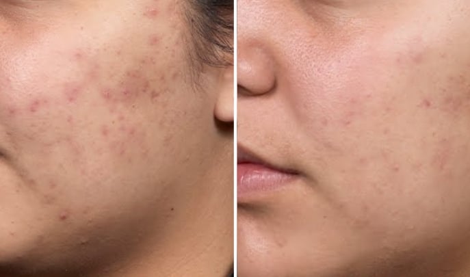 before and after acne treatment