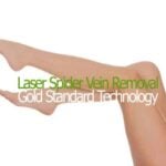 Spider Vein Removal Small Area