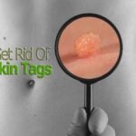 Skin Tag Removal Small