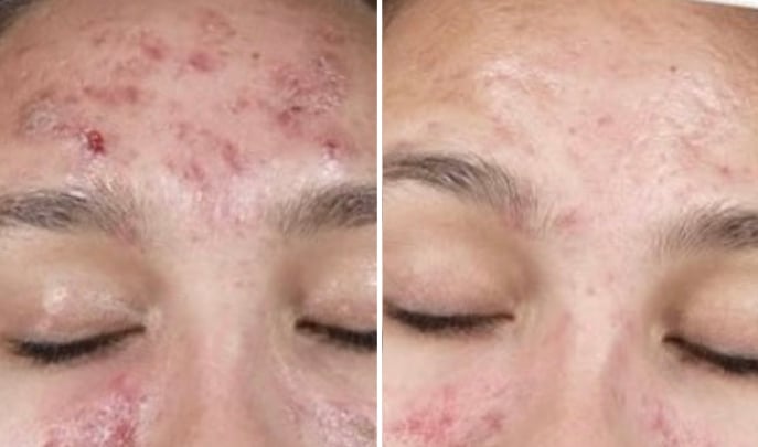 before after chemical peel