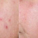 before and after acne treatment
