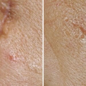 before and after acne scar treatment