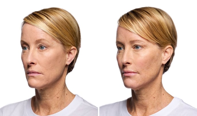 before and after dermal-fillers