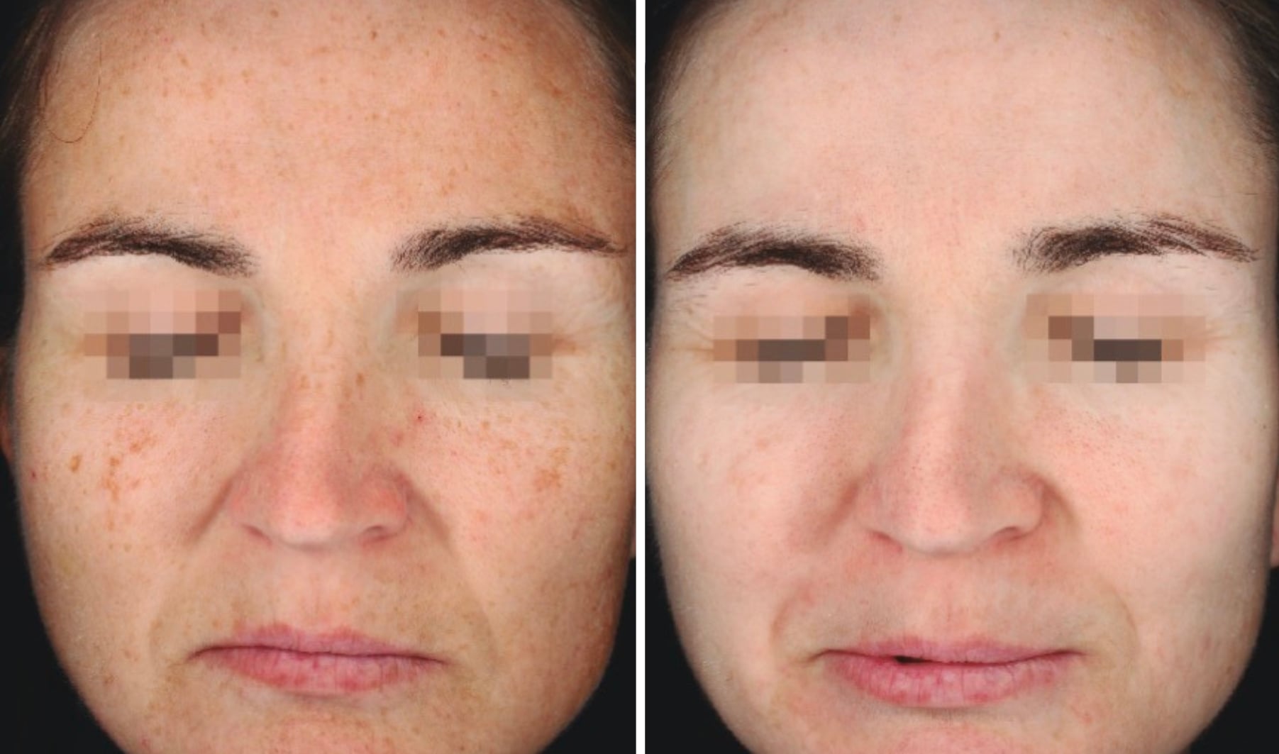 before and after dermamelan-5