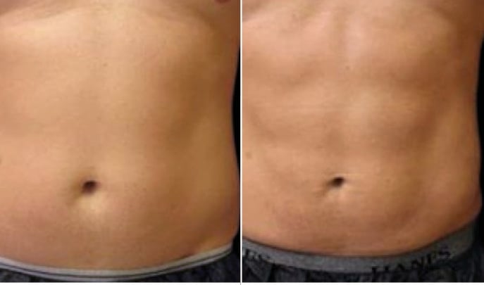 before and after emsculpt-2