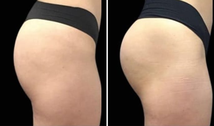 before and after emsculpt-3