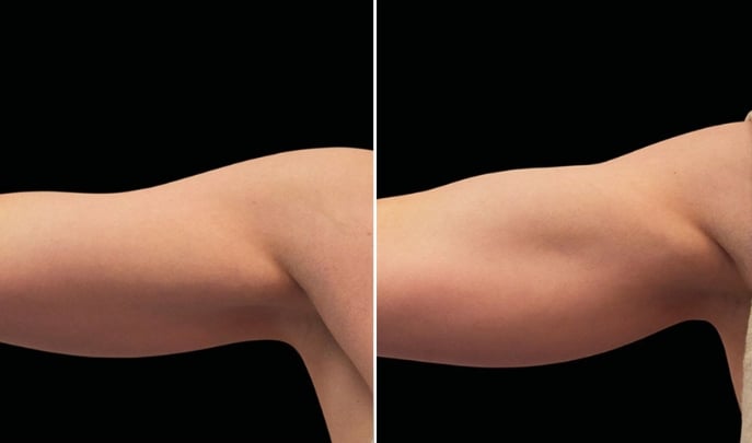 before and after emsculpt