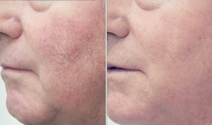 before and after face veins-3