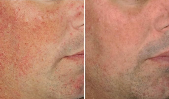 before and after face veins