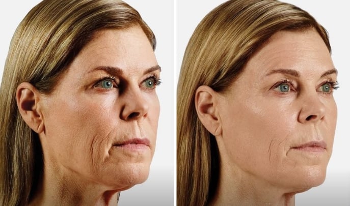 before and after fillers-3