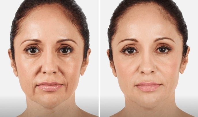 before and after fillers