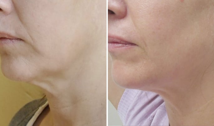 forma before and after toronto