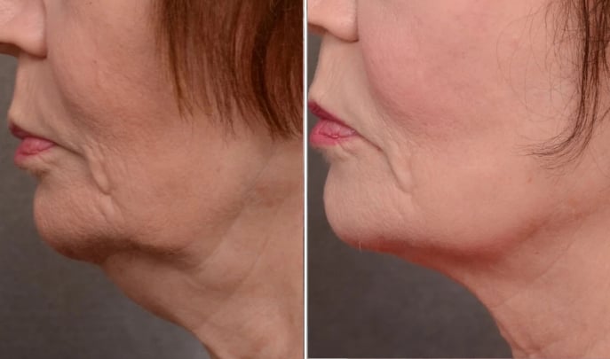 before and after forma skin tightening
