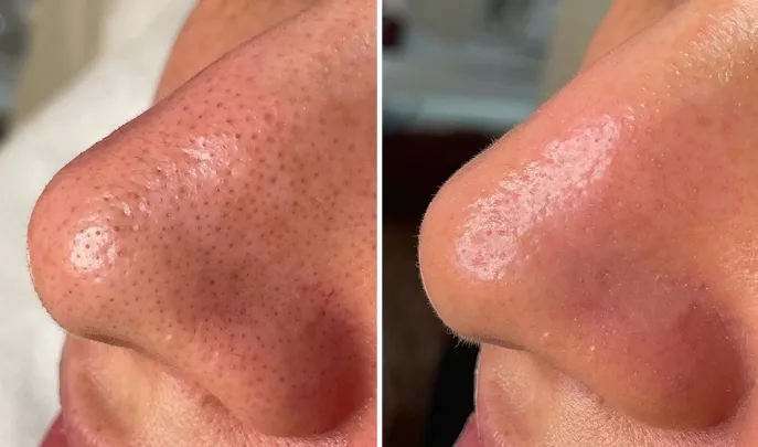 before and after hydrafacial-2