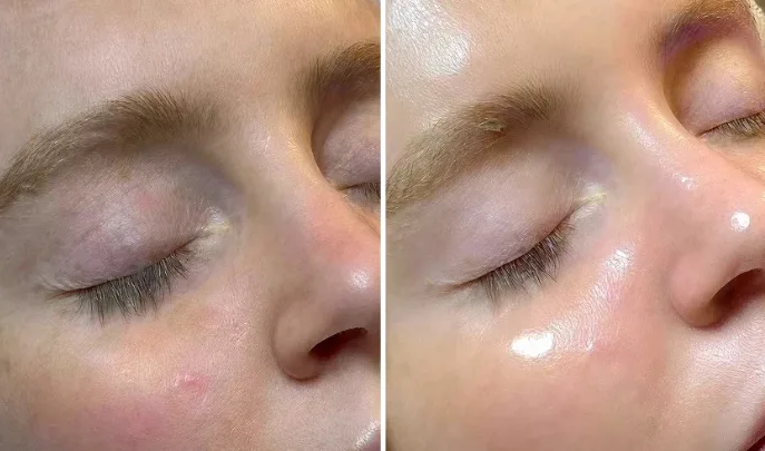 before and after hydrafacial-3