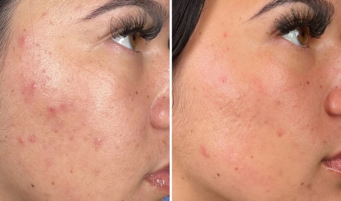 before and after hydrafacial