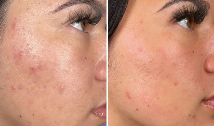 before and after hydrafacial