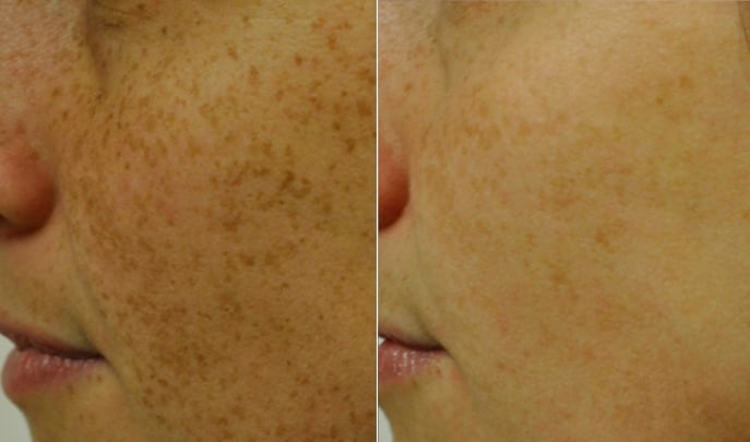before and after ipl