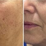 before and after laser treatment