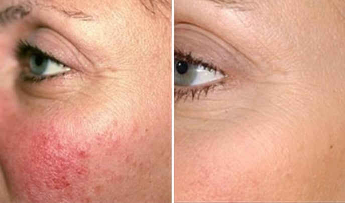 before and after laser genesis-2