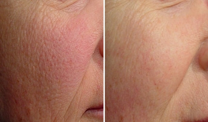 before and after laser genesis-3
