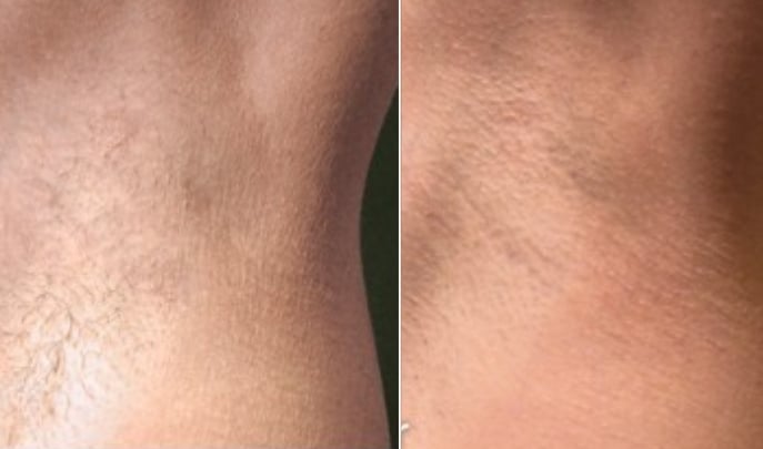 before and after laser hair removal
