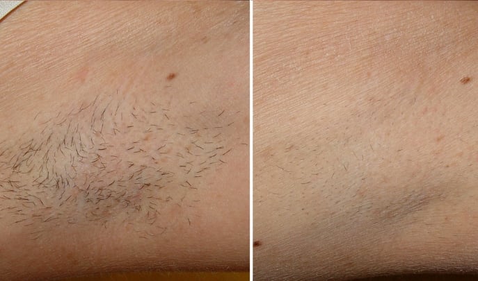 before and after laser hair removal