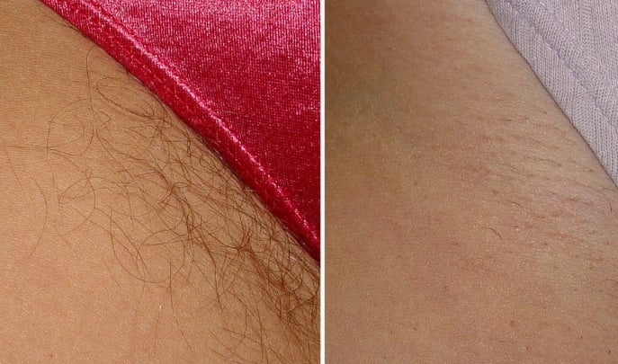 before and after laser hair removal