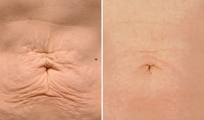 before and after skin-tightening-thermage