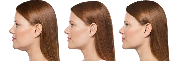belkyra-before-after