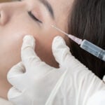 Dermal Filler By Nurse