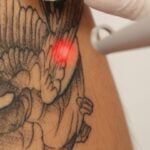 Tattoo Removal 1″ x 1″ Area pkgs