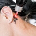 Tattoo Removal 3″ x 3″ Area pkgs