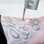 Tattoo Removal 6″ x 6″ Area pkgs