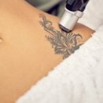 Tattoo Removal 7″ x 7″ Area pkgs