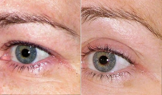 before after thermage-2