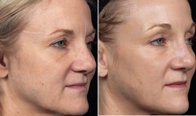 before after thermage-3