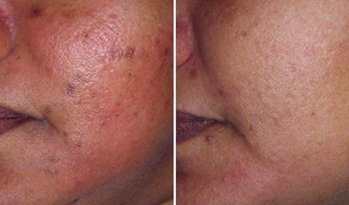 glutathione toronto Laser Genesis