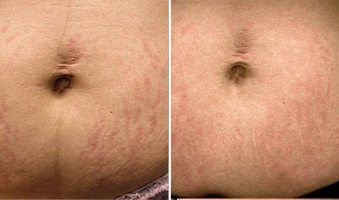 before and after laser stretchmark removal-2