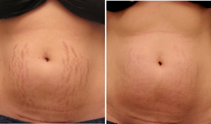 before and after laser stretchmark removal