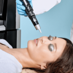 picosure treatment toronto