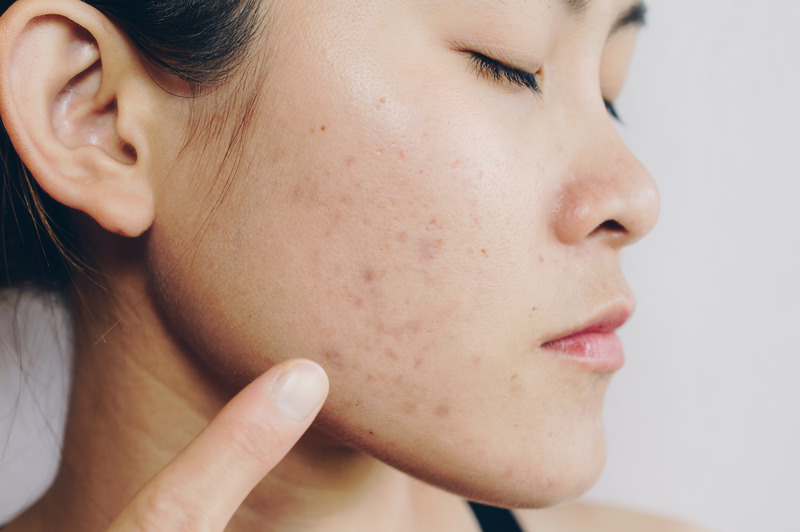 Best Clinical Treatments for Acne Scars blog image