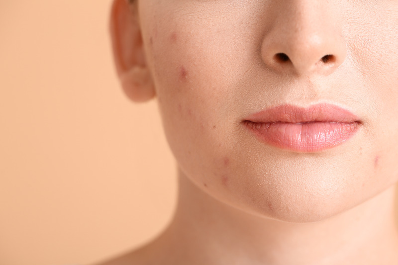 First Visit to a Toronto Acne Clinic blog image