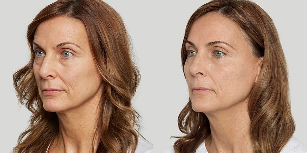 sculptra before and after